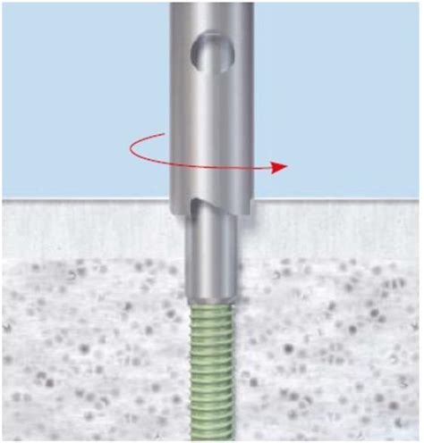 Hardware Removal: Tips And Pearls For Difficult Screws