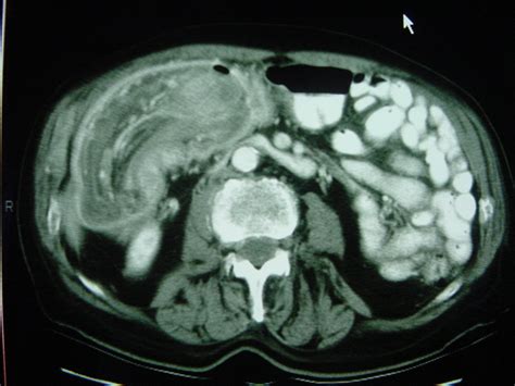 Colon Intussusception 1881 Colon Intussusception Xray 1 | Surgery Photos