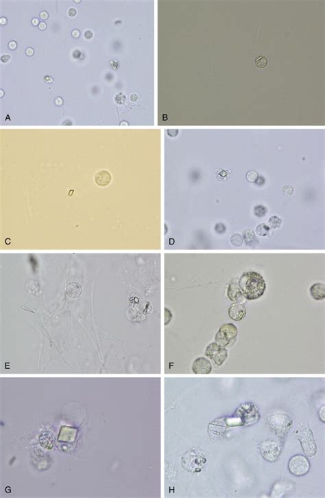 Synovial Fluid Crystal Analysis | Musculoskeletal Key