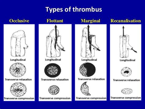 Types of thrombusOcclusive Flottant Marginal Recanalisation | Ανατομία