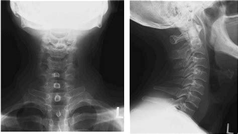 Cervical Spondylosis X Ray Image