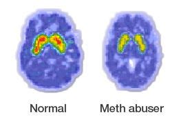 Drug Use Changes the Brain Over Time