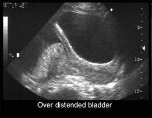 Distended Bladder Treatment, Symptoms, Causes, Diagnosis