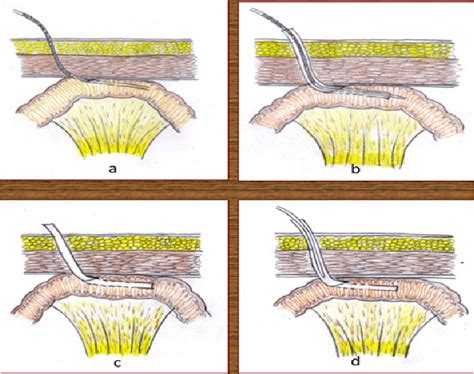 a): Blocked feeding jejunostomy tube due to resonium feeding. (b): 9 Fr... | Download Scientific ...