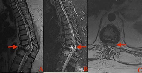 Duplication of Vertebral Pedicles Associated with a Thoracic Burst Fracture Resulting in Spinal ...