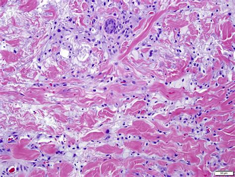 Pathology Outlines - Xanthoma