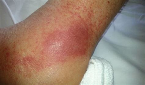 RACGP - A case of rash and arthralgias