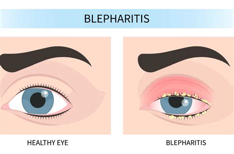 Does Laser Treatment Work For Blepharitis? | Toronto