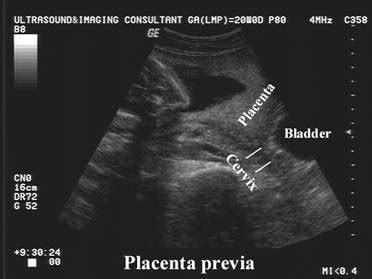 Placenta Membranacea