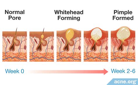 How Long Does It Take for a Pimple to Form? - Acne.org