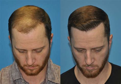 FUE Case Study: 2000 grafts into frontal forelock and hairline - Carolina Hair Surgery