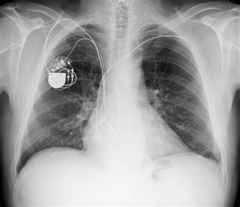 Pacemaker Chest X Ray