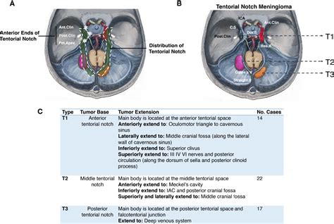 Frontiers | Surgical Management of Tentorial Notch Meningioma Guided by Further Classification ...