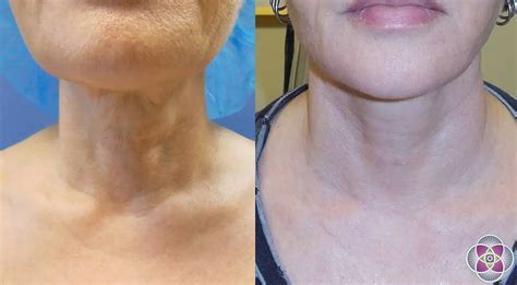 FaceTite & NeckTite Non-Surgical Jowl & Neck Tightening