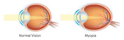 Myopia Control - All You Need To Know — Eye Academy