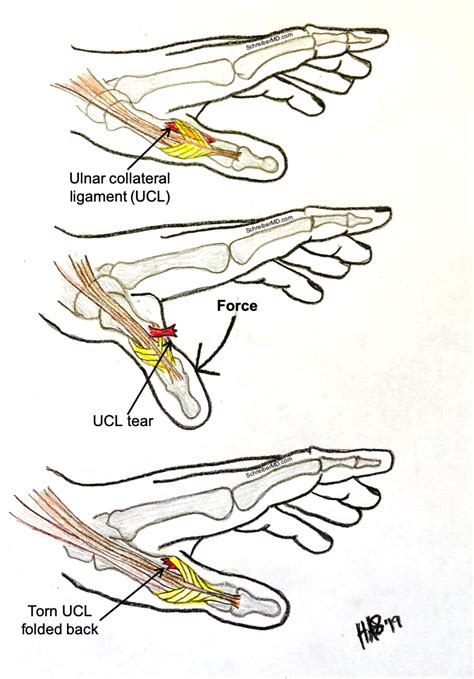 Thumb Sprains - Raleigh Hand Surgery — Joseph J. Schreiber, MD