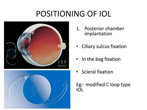 Types of iol