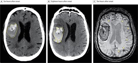 Association of Key Magnetic Resonance Imaging Markers of Cerebral Small Vessel Disease With ...