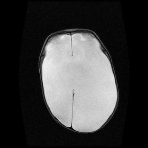 Hydranencephaly | Image | Radiopaedia.org