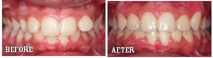 Magic of a Retainer: Before and After Photos to Prove It | New Health Advisor