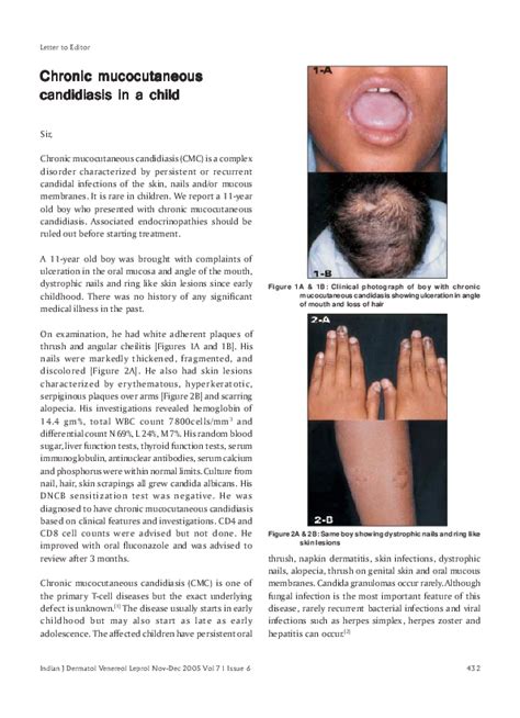 (PDF) Chronic mucocutaneous candidiasis in a child | Renu George - Academia.edu