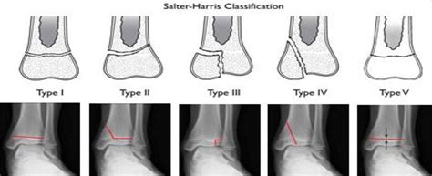 Ankle Fracture | Boston Medical Center