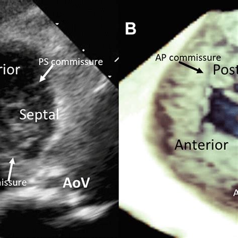 Visualization of the tricuspid valve with 2- and 3-dimensional... | Download Scientific Diagram