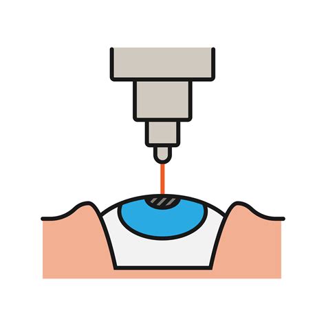 Can LASIK Eye Surgery Cure Astigmatism?