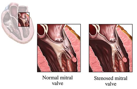 Pediatric Mitral Stenosis