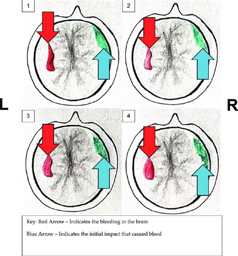 Schematic representation of a closed head injury. | Download Scientific Diagram