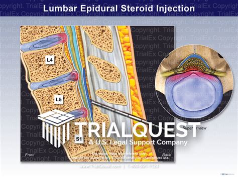 Lumbar Epidural Steroid Injection - Trial Exhibits Inc.