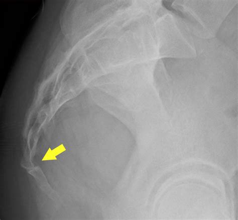 Coccyx subluxation: Coccyx pain aggravated by the prone position ...