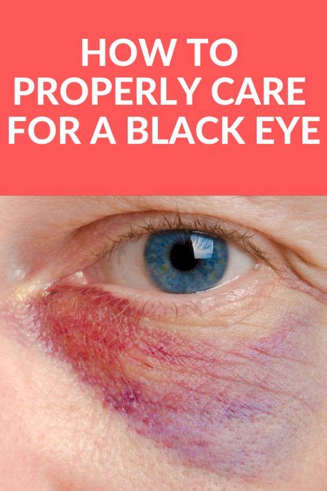 How to Properly Care for a Black Eye in 2020 | Eye black, Eye heal