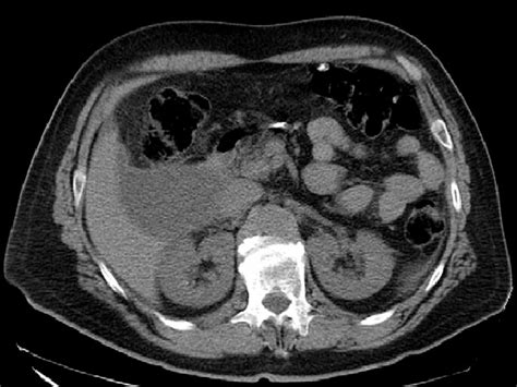 CT scan-axial view: hypodense lesion in segment VI of the liver ...