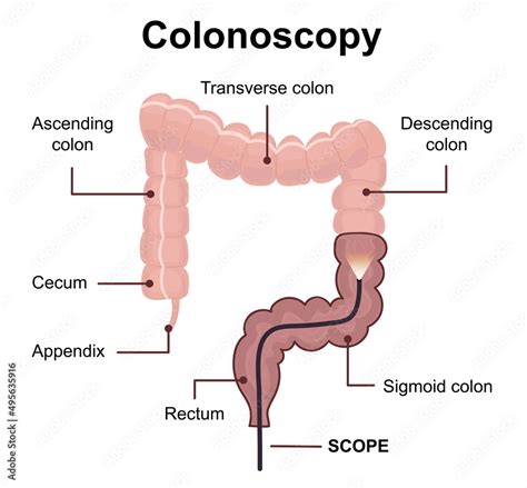 Colonoscopy technology concept with rendering endoscope inside of ...