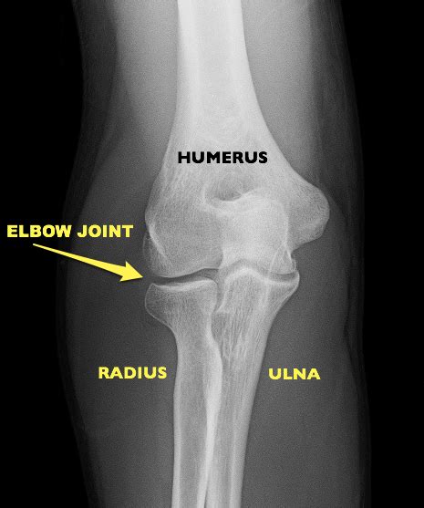 Elbow Fractures – What Patients Should Know About Broken Elbows