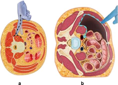 Illustrations comparing the LLIF (a) and OLIF (b) approaches. Note how... | Download Scientific ...