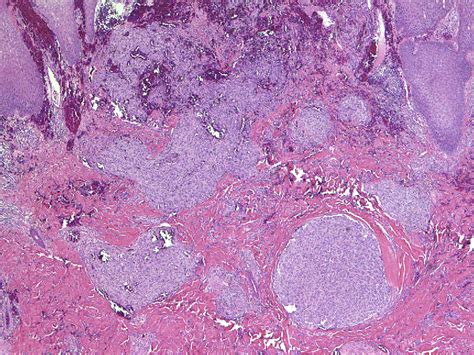 Figure 6 from Histopathology of Spindle Cell Vascular Tumors. | Semantic Scholar