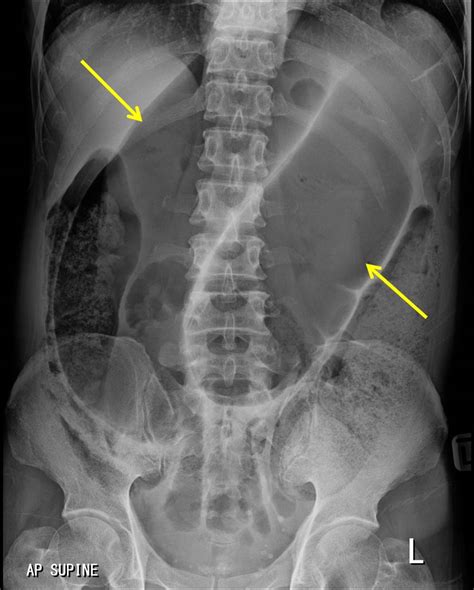 Sigmoid volvulus – Radiology Cases