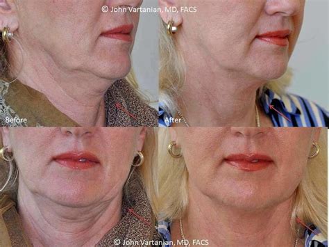 Thermage For Neck Before And After (6) » Facelift: Info, Prices, Photos, Reviews, Q&A