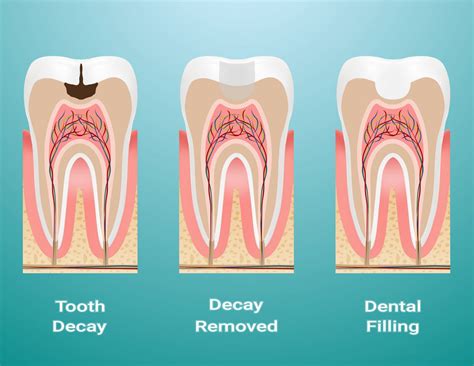 Restorations in Composite - Orozen Dental Clinics