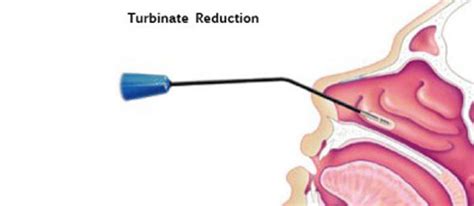 Turbinate Reduction Treatment In Atlanta, GA | Dr. Pradeep Sinha