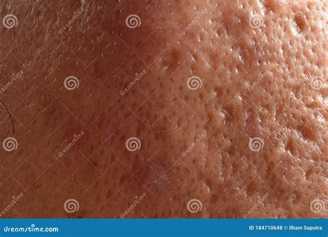 Close Up Photo of Nodular Cystic Acne Skin. Stock Photo - Image of disorders, irritation: 184710648