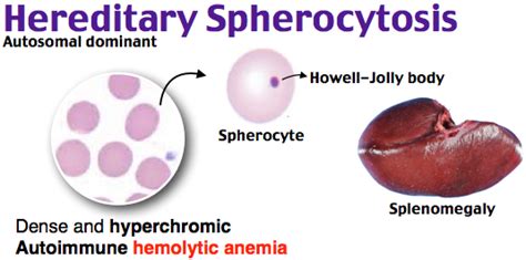 Hereditary Spherocytosis Autoimmune Hemolytic Anemia, Study Helper, Pediatric Medicine, Med Lab ...