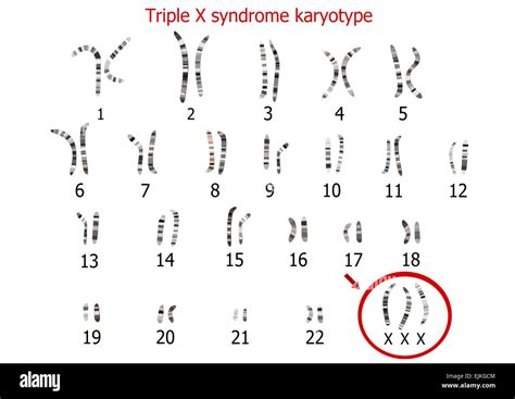 Triple X syndrome karyotype Stock Photo - Alamy