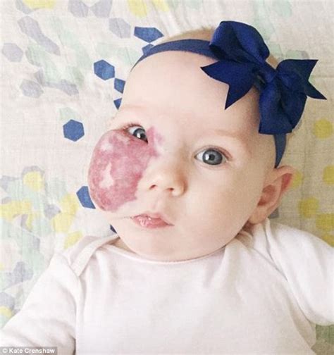 Mom of girl with large red birthmark across her face slams strangers who stare and insists it is ...