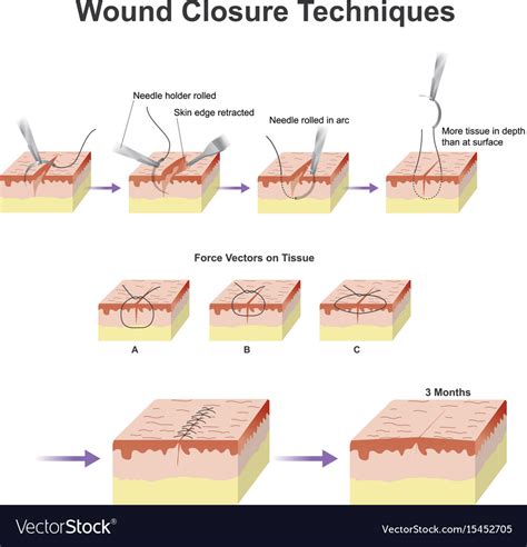 Wound closure techniques Royalty Free Vector Image