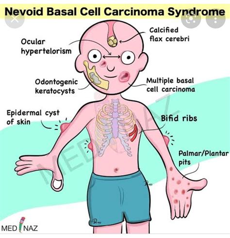 Gorlin Syndrome