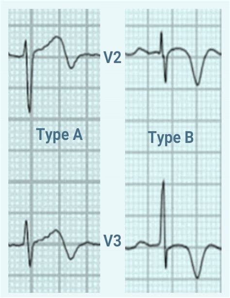 ECG patterns showing criteria and types of Wellens syndrome | Download ...