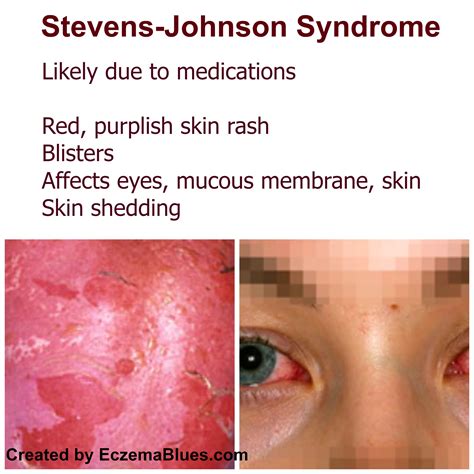 steven johnson syndrome,WHAT YOU NEED TO KNOW?